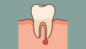 Tand klar til rodspidsamputation