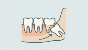 Fjernelse af visdomstænder pris